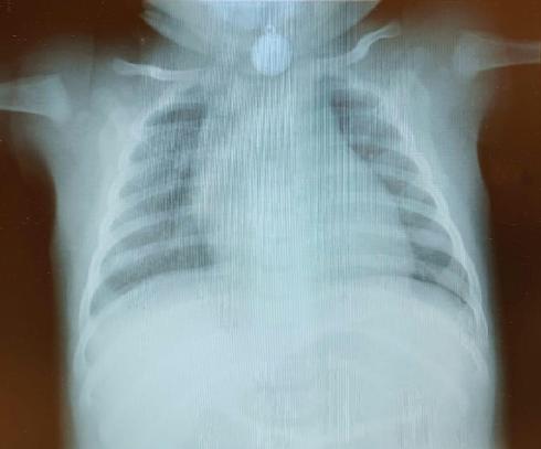 צילום הרנטגן שנערך לתינוק שבו נראה התליון