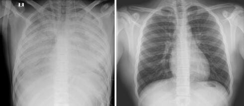 בתמונה: מימין צילום ריאות תקין. משמאל: צילום ריאותיו של הנער